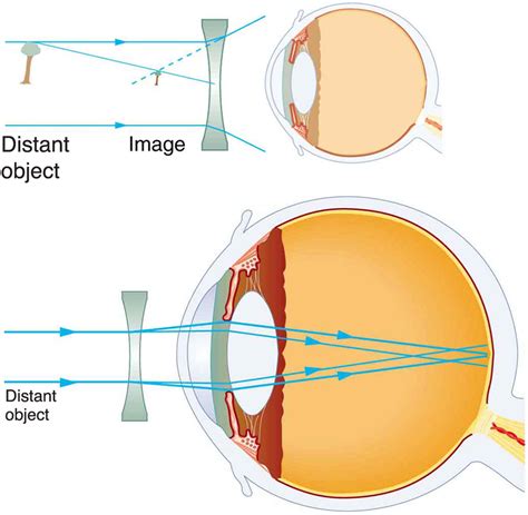 Ray Diagram For Diverging Lens