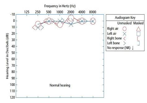 Pure Tone Audiogram: Symbols | Configuration | Interpretation