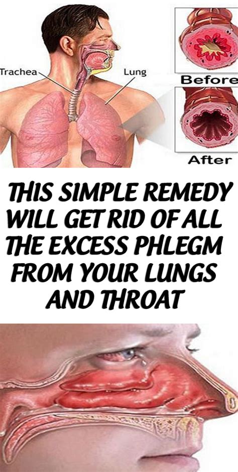 What Causes Excessive Phlegm In The Throat