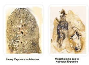 Asbestos Poisoning - Mesothelioma Info