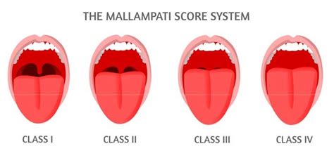 What Is The Mallampati Score? - Faceology