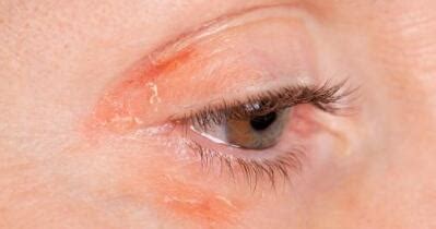 Face Psoriasis | What to Do for Psoriasis Near Eyes | Healthgrades.com