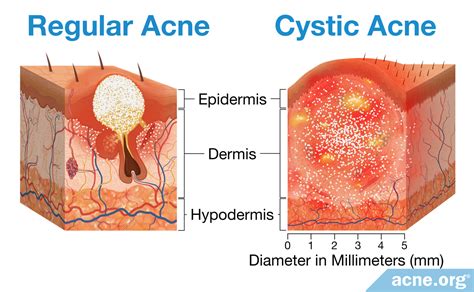 Cyst vs. Pimple: Understanding the Differences and Effective Treatments ...