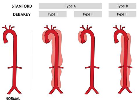 Aortic Dissection - Type A And B - Symptoms, Causes, Treatment