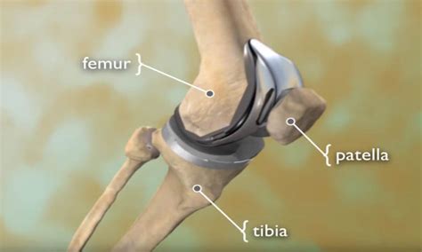 Total Knee Replacement - OrthoInfo - AAOS