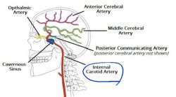 Internal Carotid Artery Occlusion Definition - mapametawan