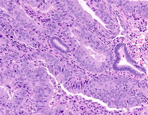 Atypical Endometrial Hyperplasia : (PDF) Atypical Endometrial ...