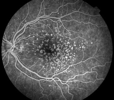 Basal Laminar Drusen: Full report - Ophthalmology Education