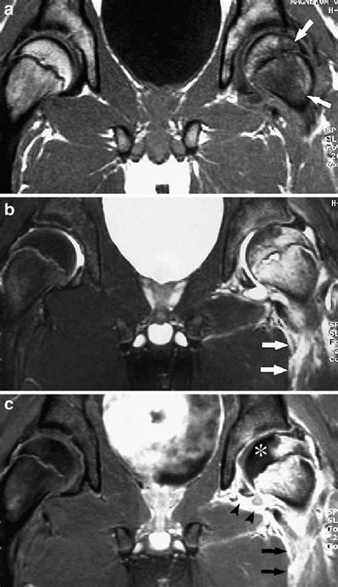 MR images of a 15-year-old boy with septic arthritis of the left hip. a ...