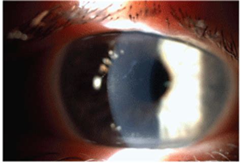 Anterior Basement Membrane Dystrophy Surgery - Openbasement