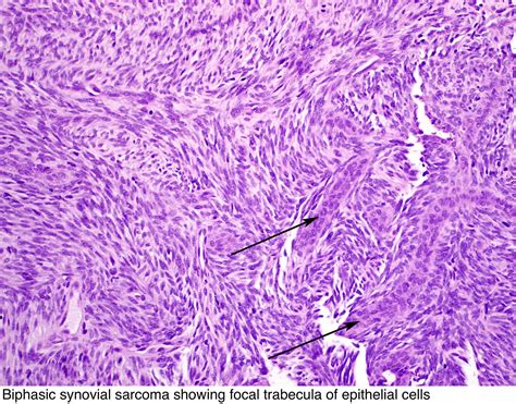 Pathology Outlines - Synovial sarcoma