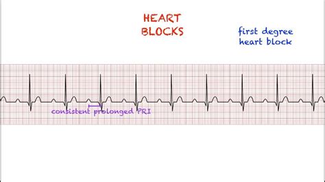 Ecg Blocks Made Easy