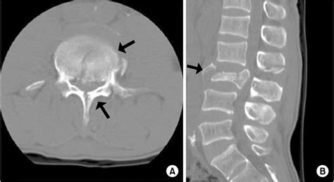 Axial (A) and sagittal (B) CT scans show L3 burst fracture with ...