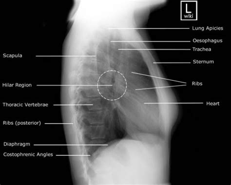 10 Kriteria Foto Thorax yang Baik (PA) serta Tips dan Trik memotret ...