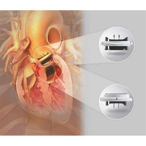 On-X prosthetic heart valve - cardiac surgery | Biomedica Tunisia