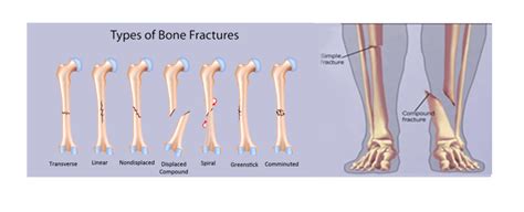 5 Different Types Of Fractures