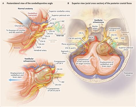 Vestibular Schwannomas | NEJM