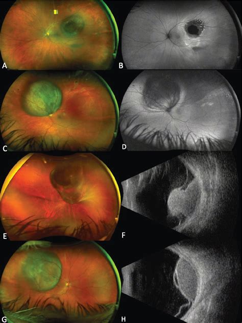 Choroidal Nevus With Lipofuscin