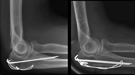 Predicting secondary surgery after operative fixation of olecranon ...