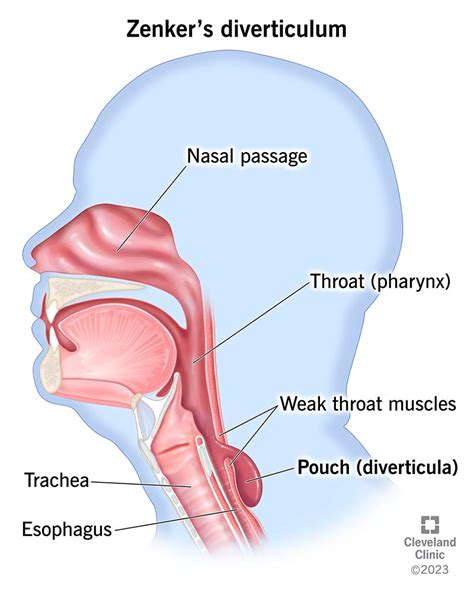 Zenker’s Diverticulum: Symptoms, Causes & Treatment