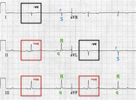 Left Posterior Fascicular Block (LPFB) • LITFL • ECG Library Diagnosis