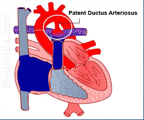 Conus Arteriosus