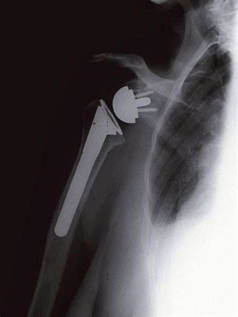 Reverse Total Shoulder Replacement - OrthoInfo - AAOS