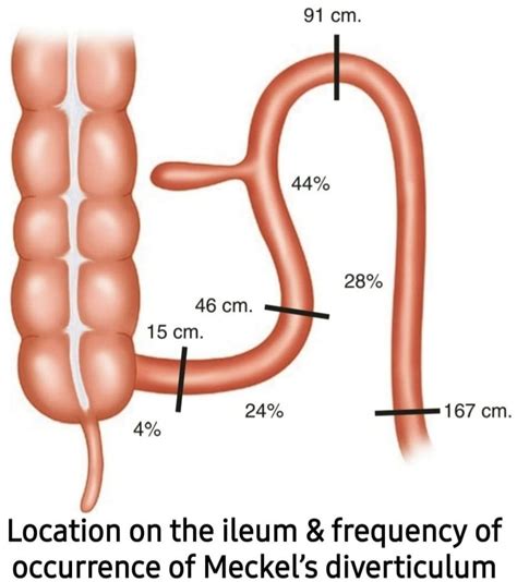 Meckel Diverticulum