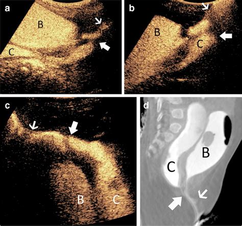 Cloacal malformation in a 4-month-old girl. a–c Contrast-enhanced ...