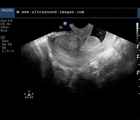 cochinblogs: Sonography in the case of pedunculated polyp