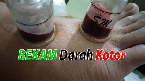 Bekam Jakarta Barat - Homecare24