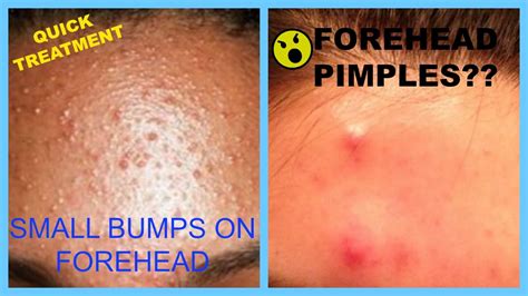 Acne Home Remedies For Dry Skin: Forehead Pimples Home Remedies