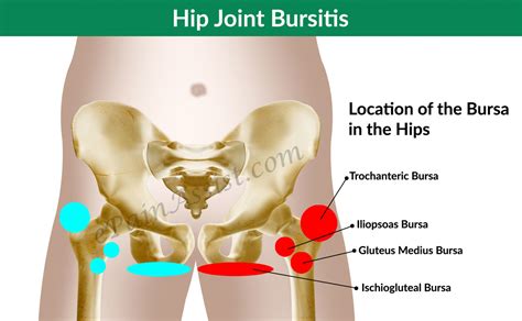 Hip Joint Bursitis & Tendinitis- Causes, Signs, Symptoms, Diagnosis ...