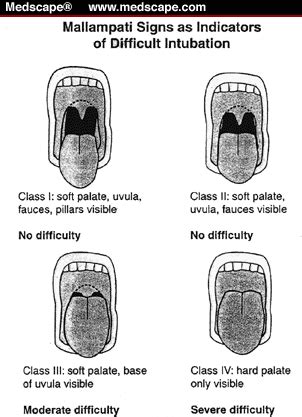 Do YOU Know your Mallempati Score? - Chief Medical Officer Notes