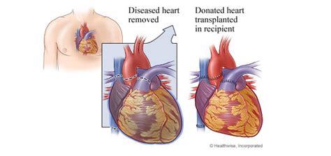 Heart Transplant