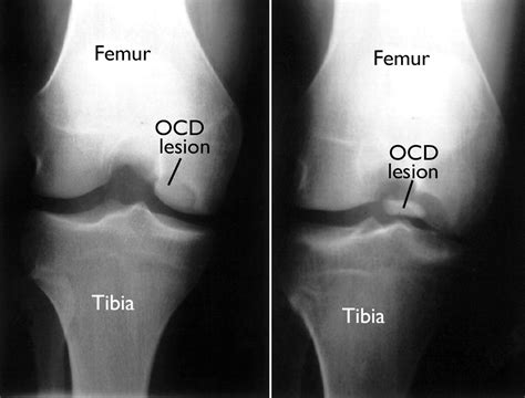 Osteochondritis Dissecans After Surgery