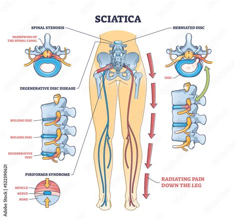 Sciatica pain or nerve weakness as leg lumbar radiculopathy outline ...