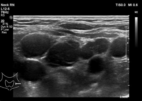 Lymphoma Action | Ultrasound and X-ray scans