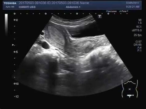 Cervical Polyp On Ultrasound