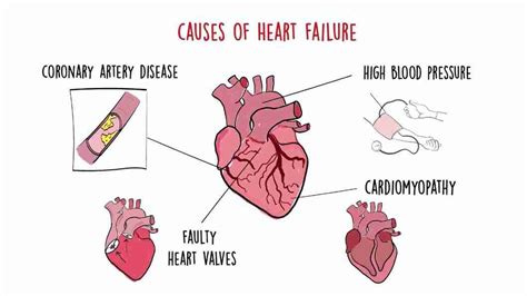 Congestive Heart Failure: Symptoms, Causes, Types, Treatment & Prevention