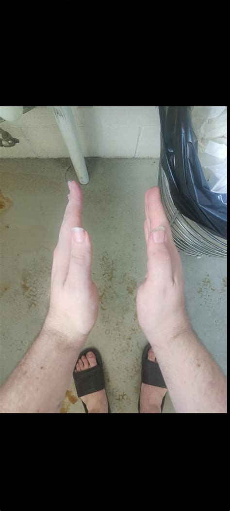 THENAR atrophy of right hand. : r/MuscleTwitch