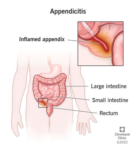 Understanding Appendicitis Symptoms and Treatment - Ask The Nurse Expert