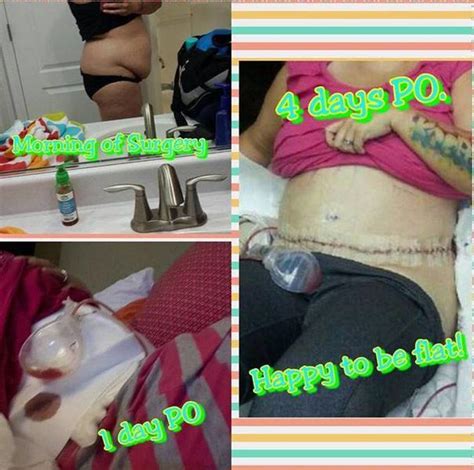 Gallery of tummy tuck before and after photos » Tummy Tuck: Prices ...