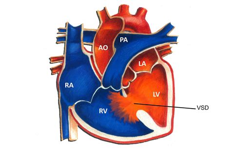 Ventricular Septal Defect Anatomy