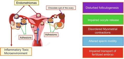 Endometriosis and subfertility | Obgyn Key