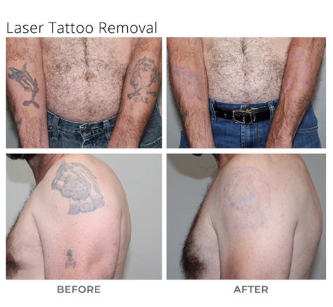 Laser Tattoo Removal - MSA Plastic Surgery