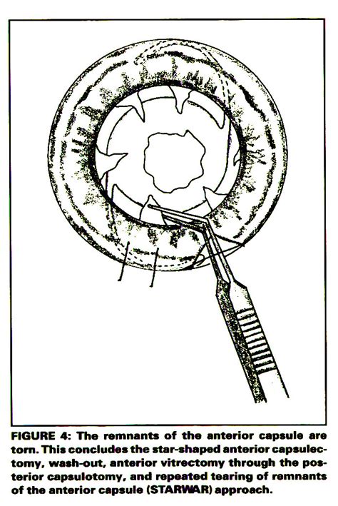 Procedures Involving StarShaped Capsulectomy for Managing Congenital ...