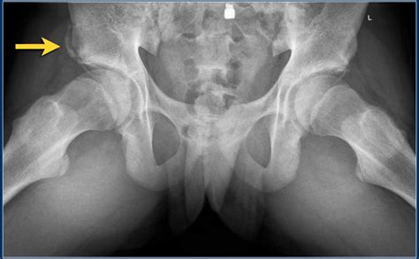 The Radiology Assistant : Hip pathology in Children