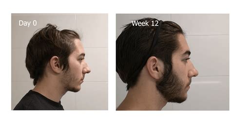 3 month Minox before and after : r/minoxidil