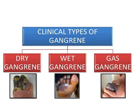 Gangrene - The Dead Tissues! - medical emergency - Santripty